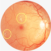 An image of an eye with Diabetic Maculopathy. 
