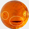 An image of an eye with Proliferative diabetic retinopathy.