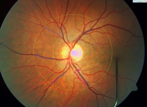 Diabetes Retinal Damage Study 2