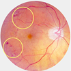 An image of an eye with Preproliferative Diabetic Retinopathy